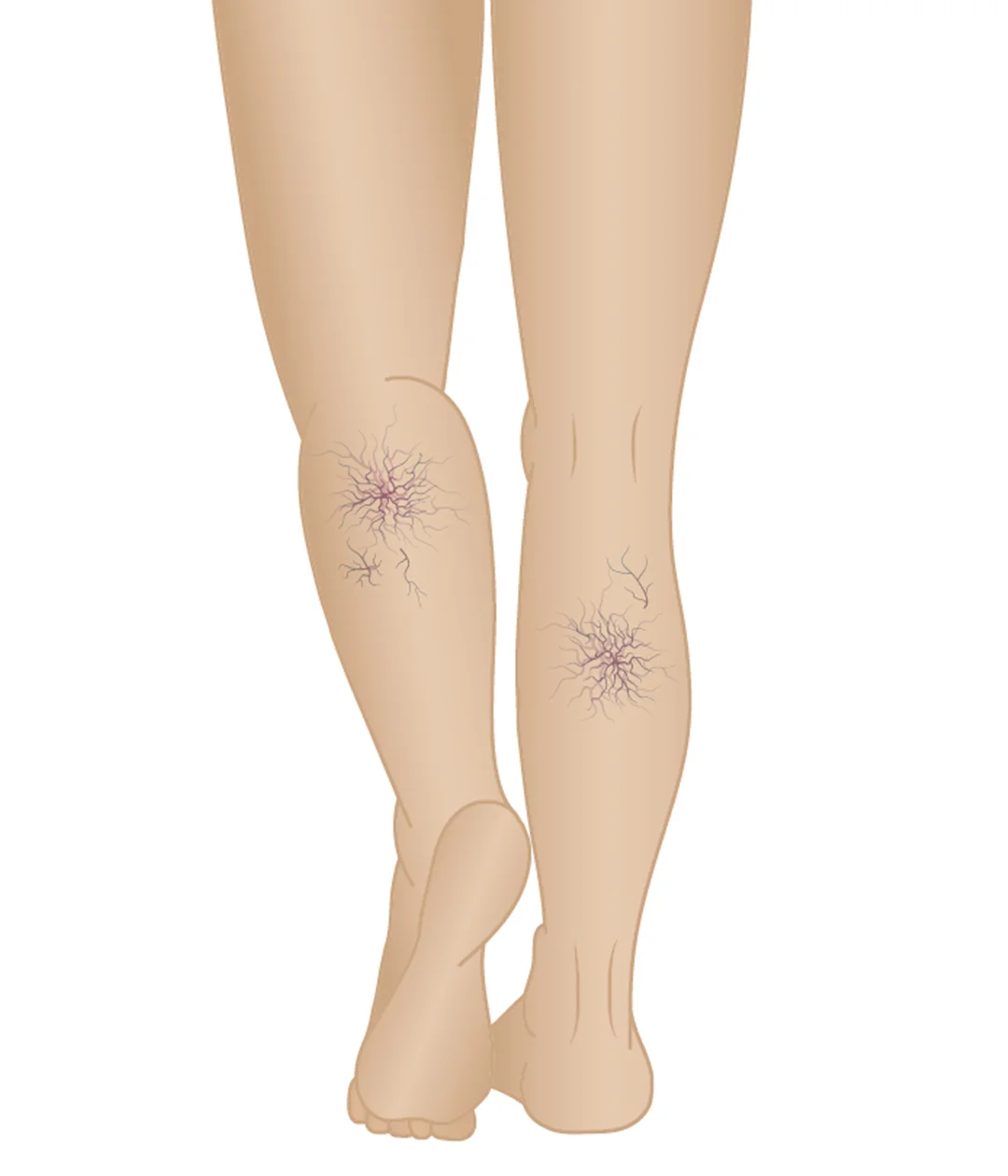 Stages of Varicose Veins Phase 2 Spider Veins