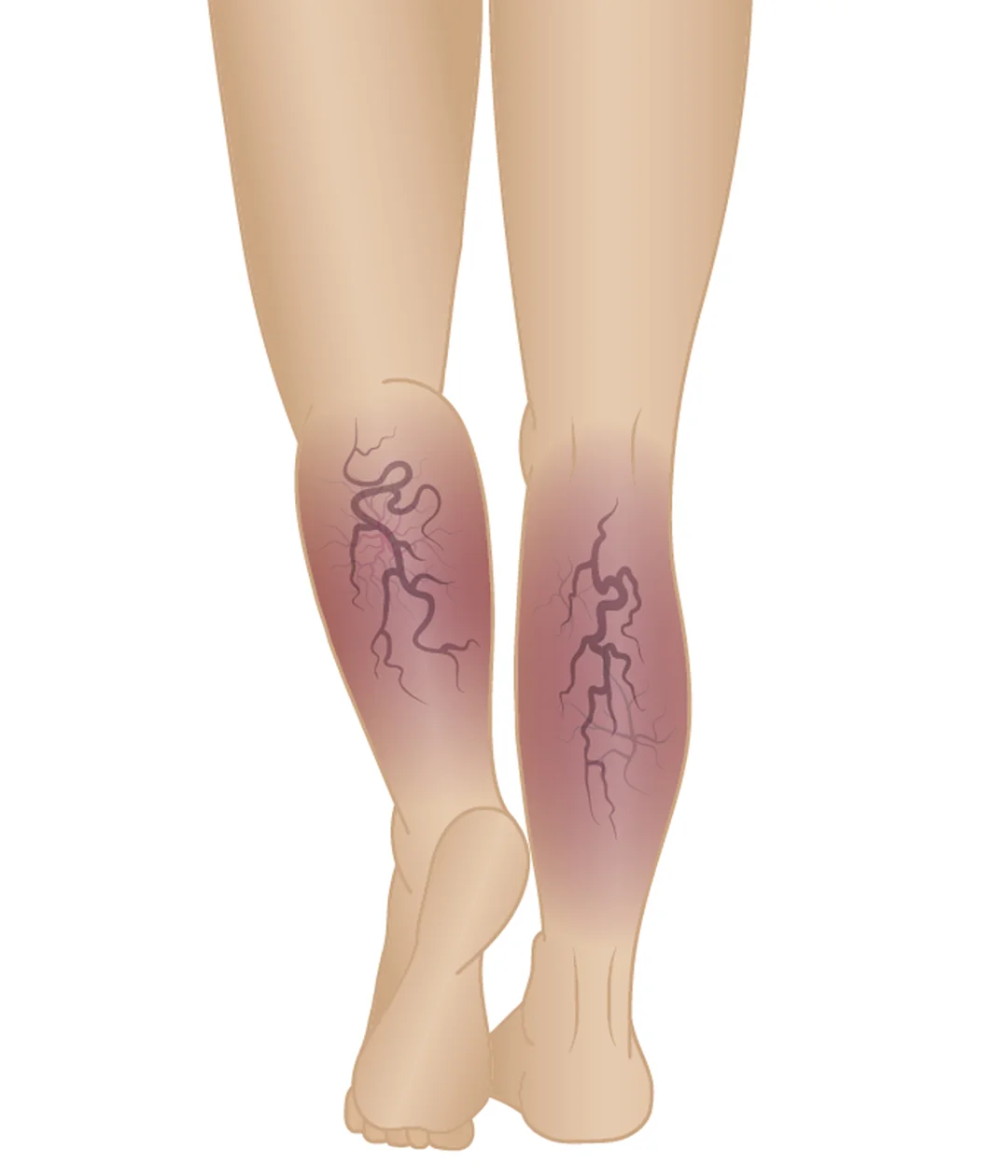 Stages of Varicose Veins Phase 5 Chronic Venous Insufficiency