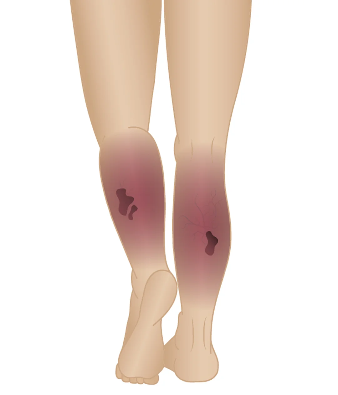 Stages of Varicose Veins Phase 6 Venous Ulcer