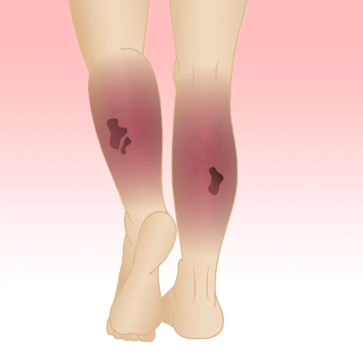 Varicose Ulcer Treatment in Mumbai The Vein Center Mumbai Pic