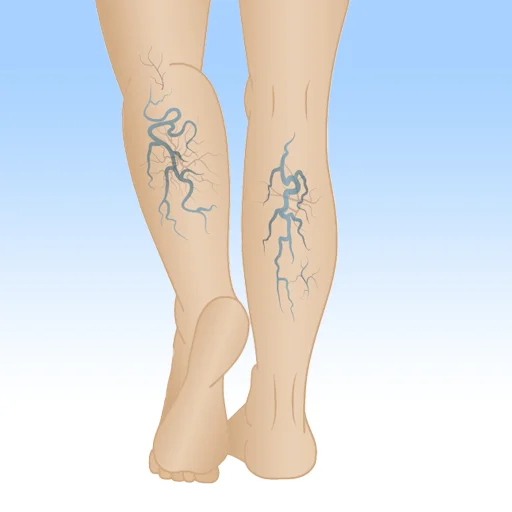 Varicose Veins Treatment in Mumbai The Vein Center Mumbai Pic