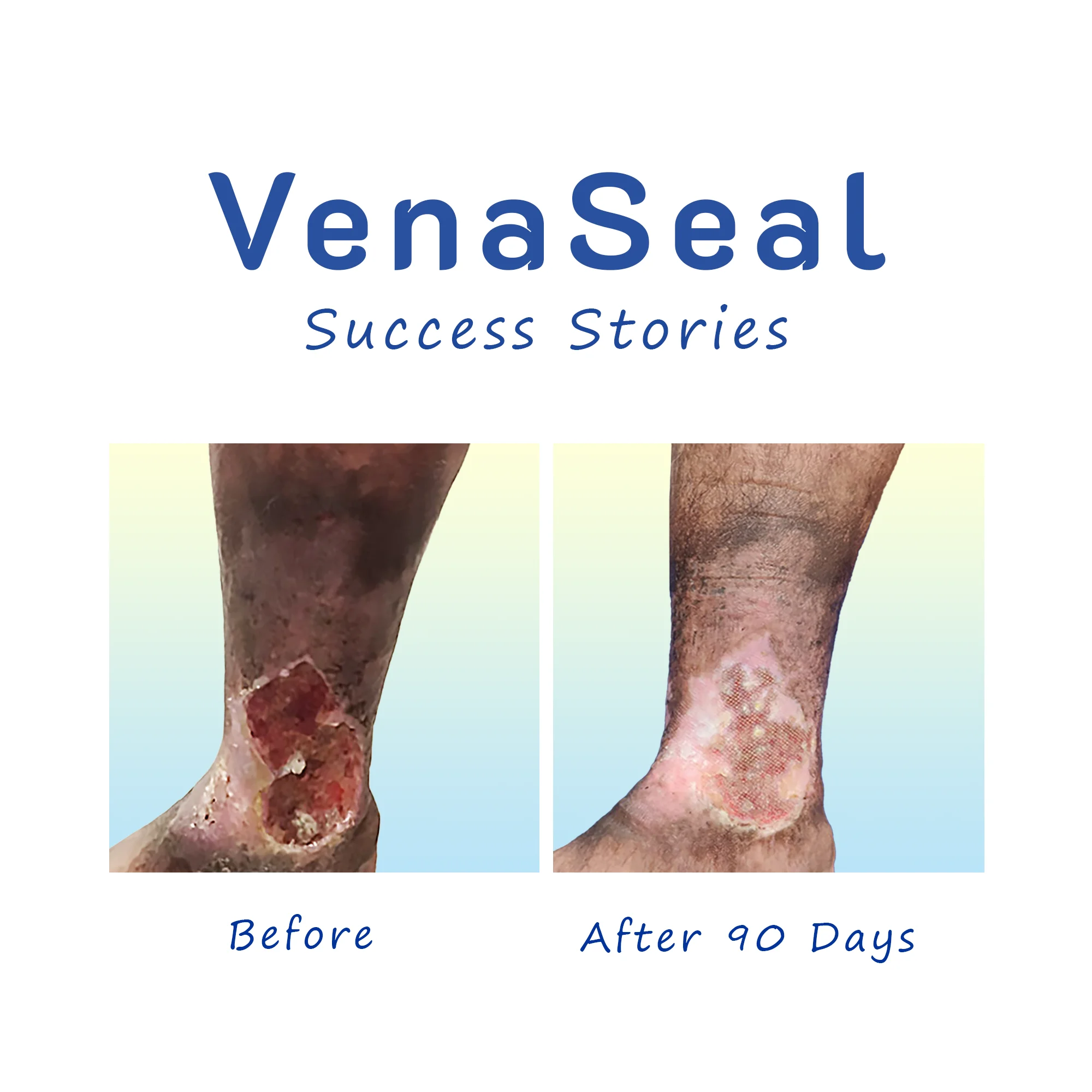 Venous Ulcer VenaSeal success stories before after pic