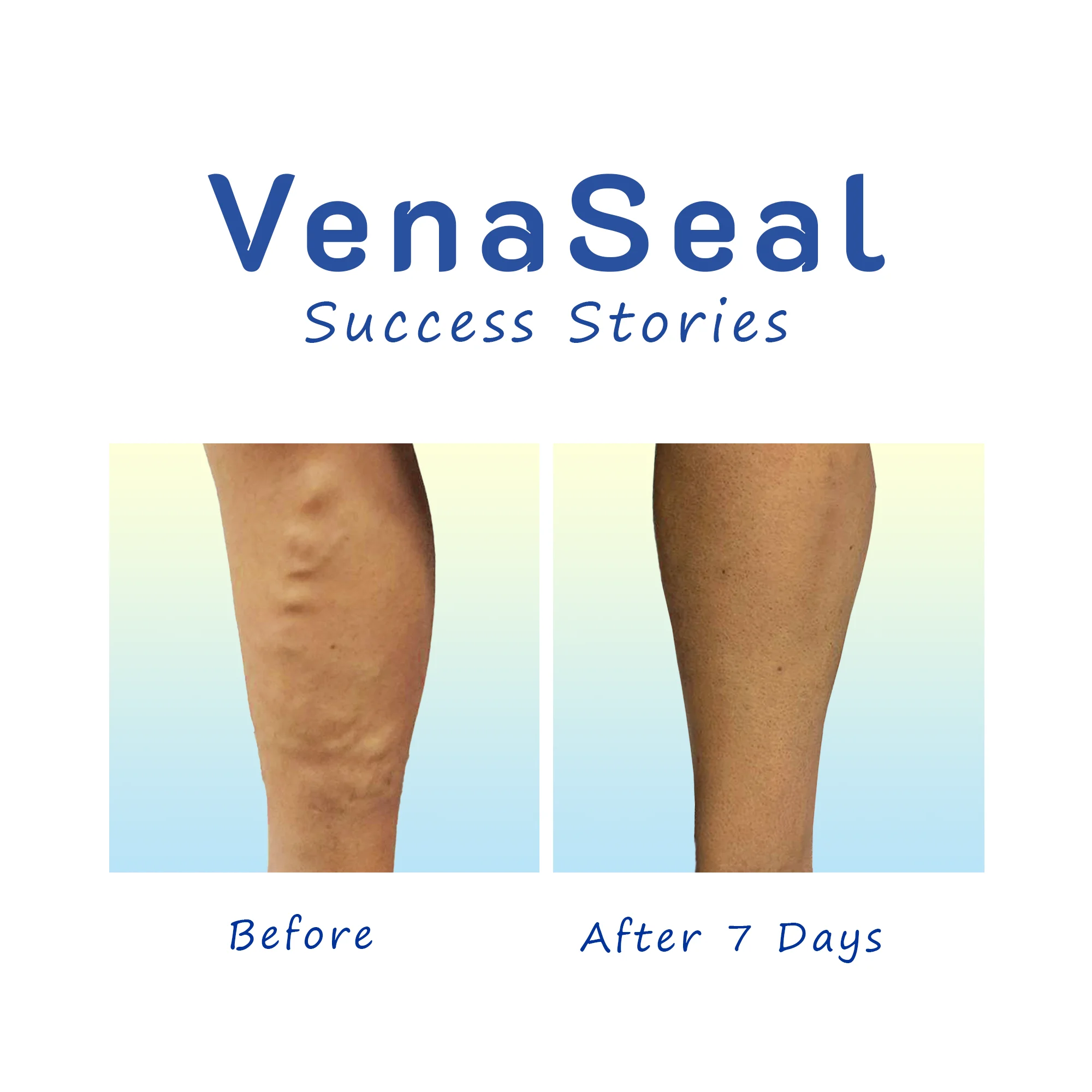 Varicose Veins VenaSeal success stories before after pic