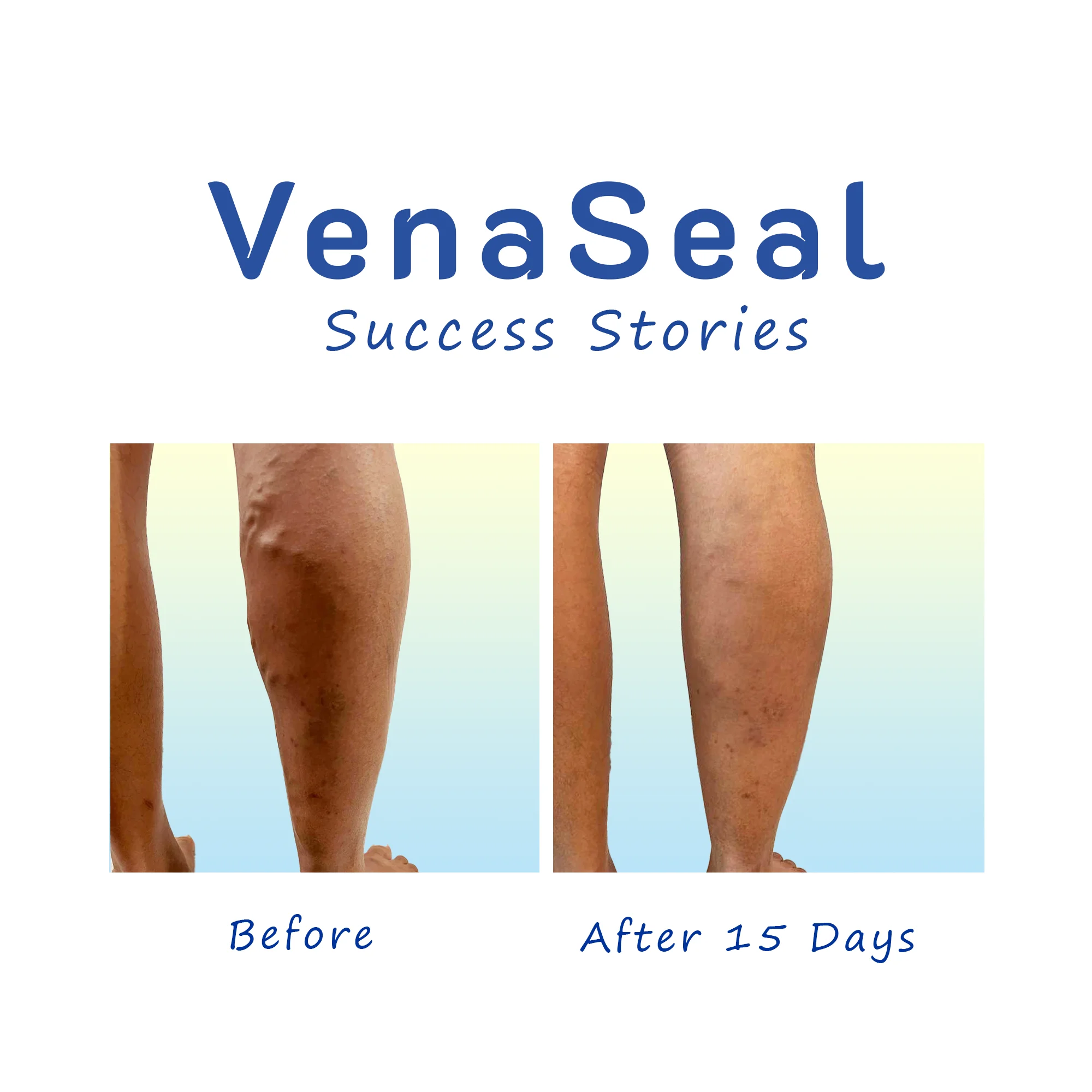 Varicose Veins VenaSeal success stories before after pic