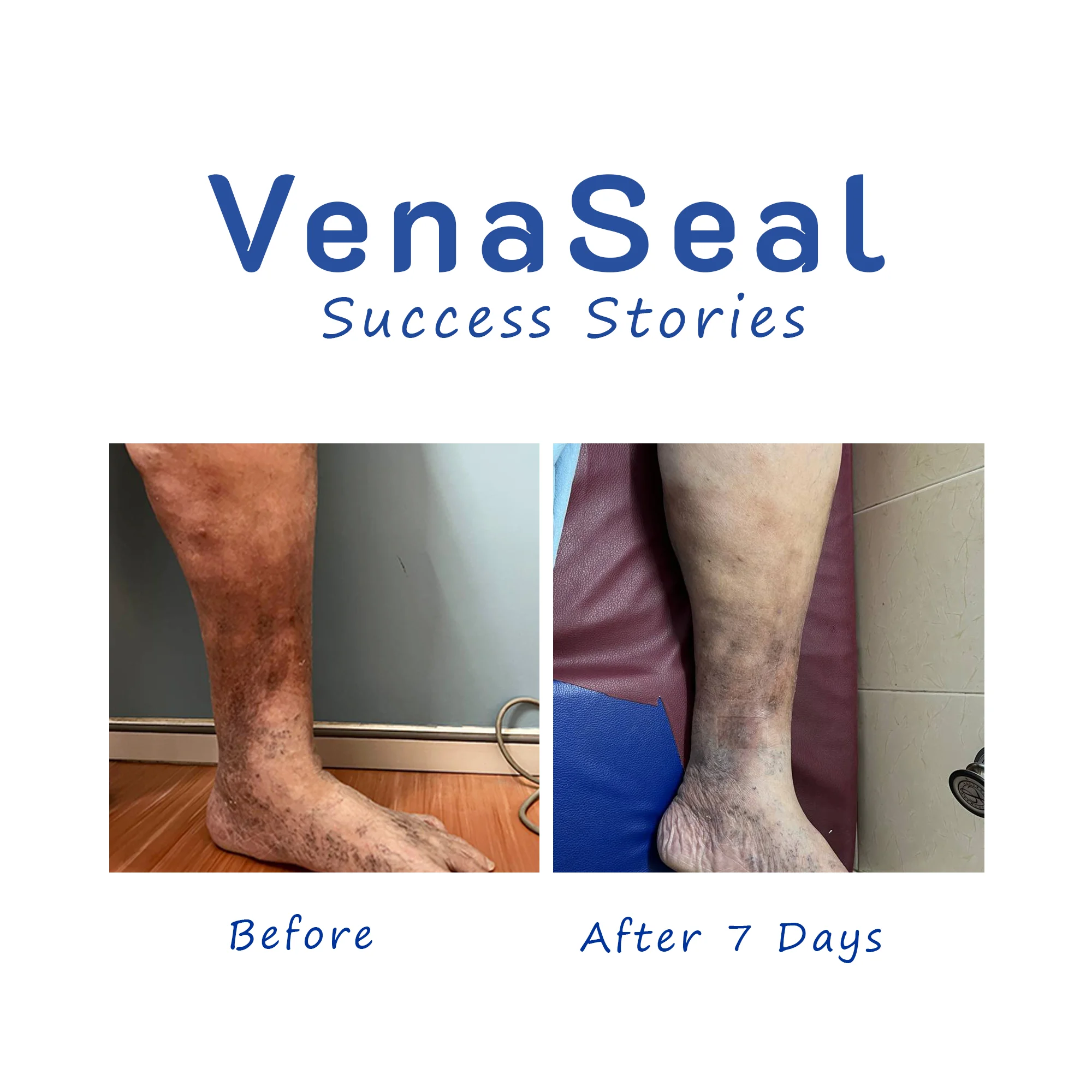 Venous Ulcer VenaSeal success stories before after pic