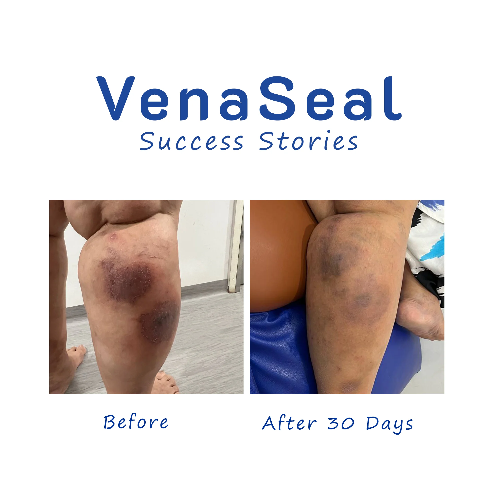 Venous Ulcer VenaSeal success stories before after pic