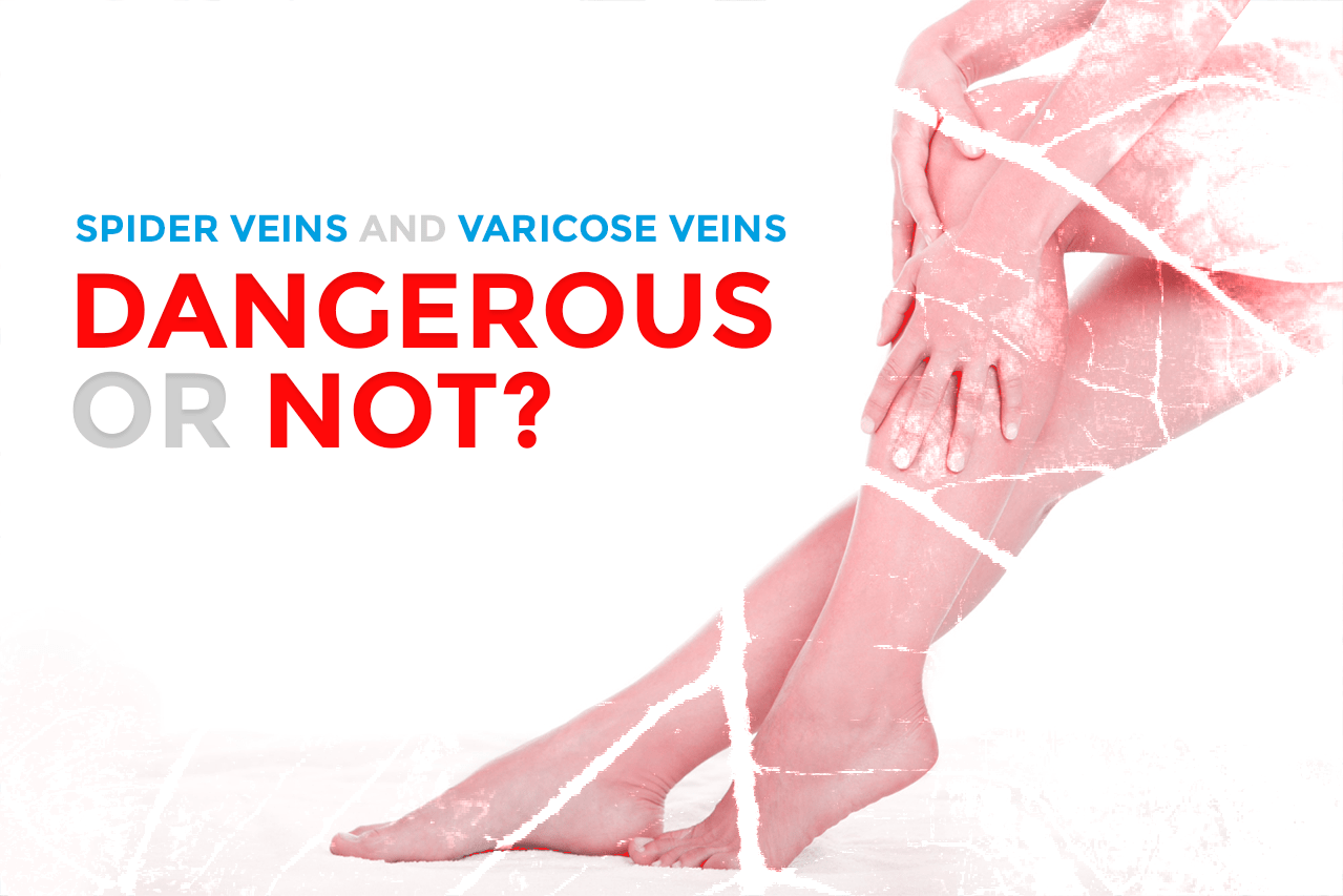 Are spider veins and varicose veins dangerous? - The Vein Center Mumbai