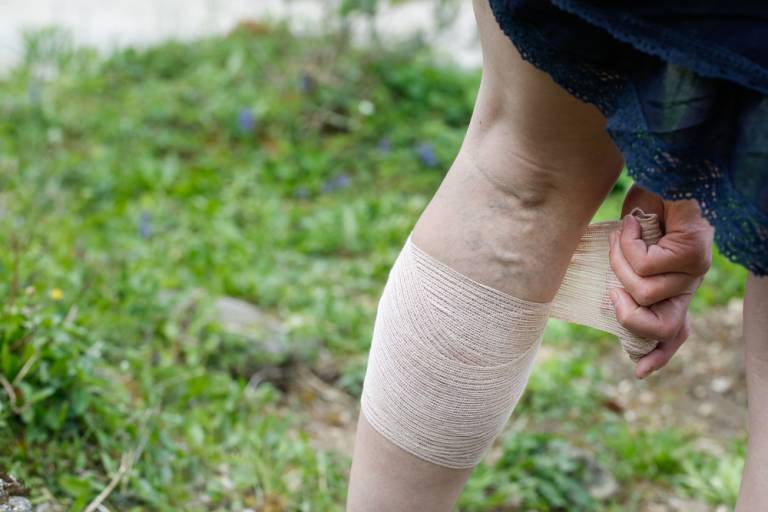 Identifying the Risk Factors Varicose Veins